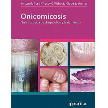ONICOMICOSIS