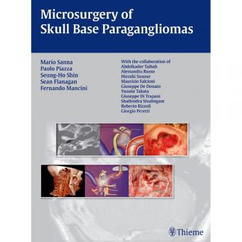 Skull Base Paraganglioma Microsurgery Guide