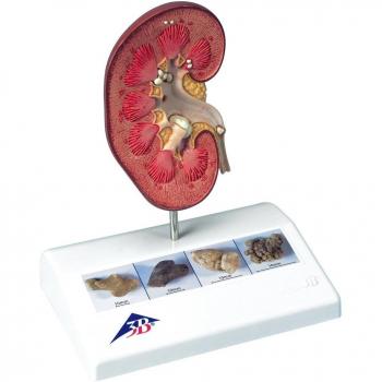 3B Scientific K29 Modelo de anatomía humana Modelo de Cálculo Renal + software de anatomía gratuito - 3B Smart Anatomy
