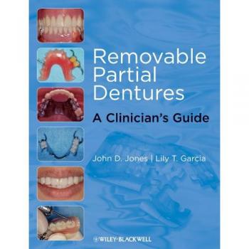 Removable Partial Dentures: A Clinician's Guide
