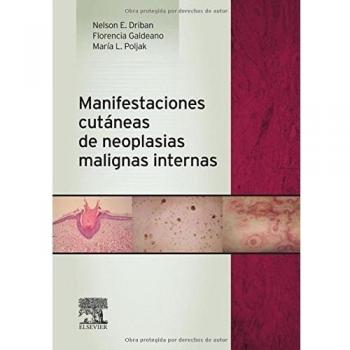 Manifestaciones Cutáneas De Neoplasias Malignas Internas