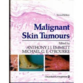 Malignant Skin Tumours