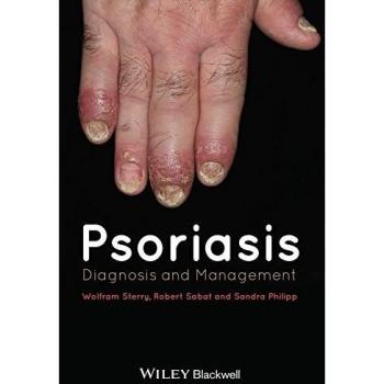 Psoriasis: Diagnosis and Management