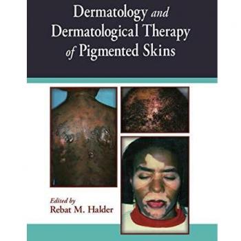Dermatology and Dermatological Therapy of Pigmented Skins