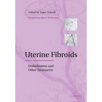 Embolización de Fibromas Uterinos: Tratamientos Efectivos y Alternativas