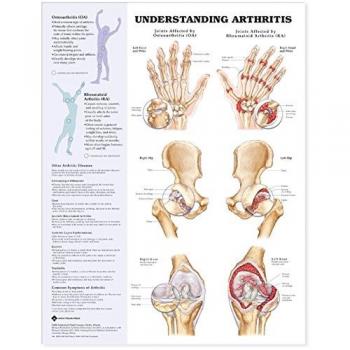 Understanding Arthritis