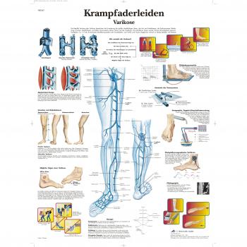 3B Scientific VR0367UU - Póster explicativo sobre las varices