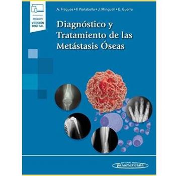 Diagnostico y tratamiento de las metastasis oseas