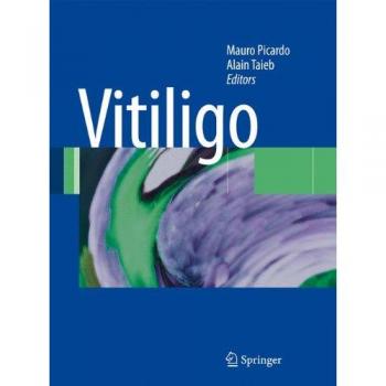 Vitiligo