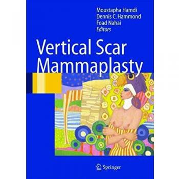 Vertical Scar Mammaplasty