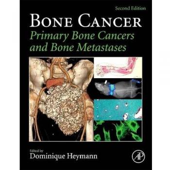 Bone Cancer: Primary Bone Cancers and Bone Metastases
