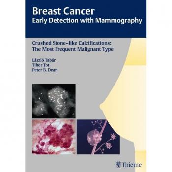 Mammography Guide: Early Detection of Breast Cancer with Crushed Stone-Like Calcifications