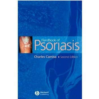 Handbook of Psoriasis