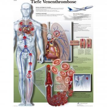 3B Scientific VR0368L - Póster explicativo sobre la trombosis venosa profunda