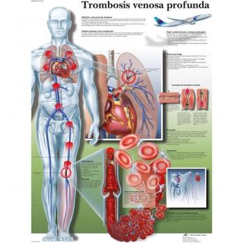 3B Scientific VR3368L Impreso En Papel, Trombosis Venosa Profunda