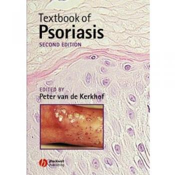 Textbook of Psoriasis