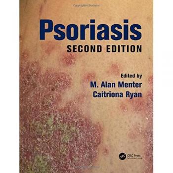 Psoriasis