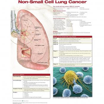 Cáncer de pulmón antialto.