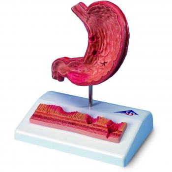3B Scientific K17 Modelo de anatomía humana Estómago Con Úlceras Gástricas + software de anatomía gratuito - 3B Smart Anatomy