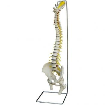 Columna vertebral con hernias discales/modelo anatómico