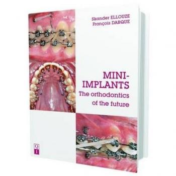 Mini-Implants: The Orthodontics of the Future