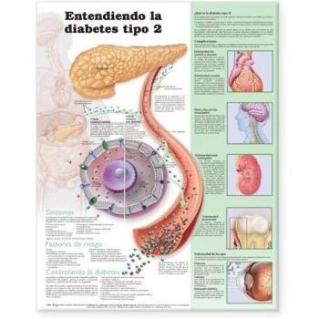 Understanding Type 2 Diabetes Anatomical Chart in Spanish