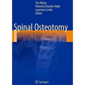 Springer Spinal Osteotomy System