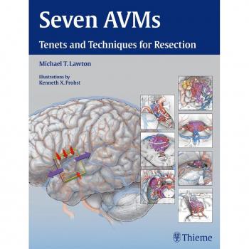 Thieme Medical Publishers Seven AVMs: Principles and Techniques for Resection of Arteriovenous Malformations